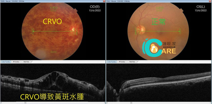 視覺科學博士視光師 Dr. Marco 個案分享: 眼睛中風的一種 - 視網膜中央靜脈阻塞 (Central Retinal Vein Occlusion, CRVO) - iCARE EYECARE 護眼·家