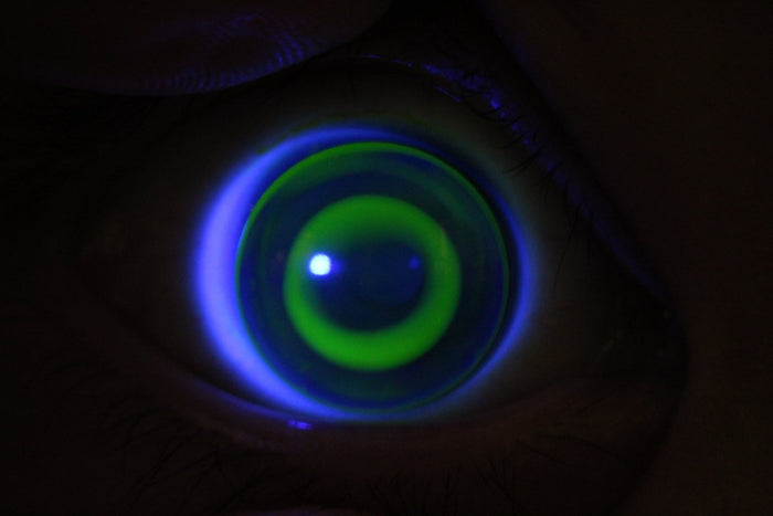 視覺科學博士視光師 Dr. Marco 角膜矯視OK鏡個案分享: 活躍小女孩A - iCARE EYECARE 護眼·家