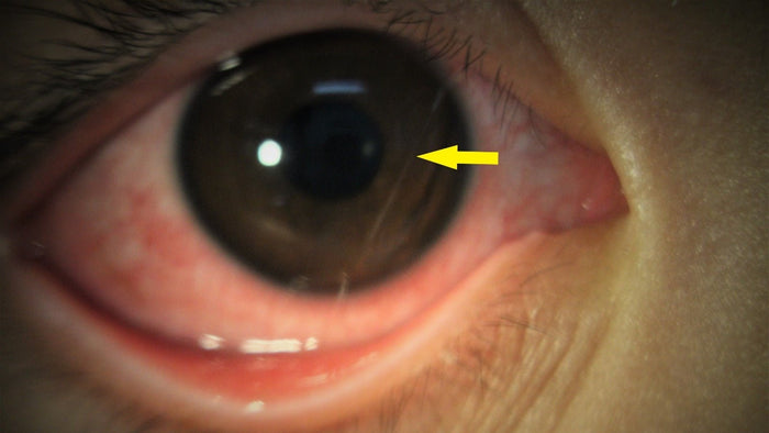 【江志榮博士】【過敏性結膜炎】Ooey ooey ooey allergies - iCARE EYECARE 護眼·家