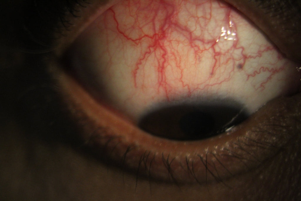 iTear 自身淚液促進器 - iCARE EYECARE 護眼·家