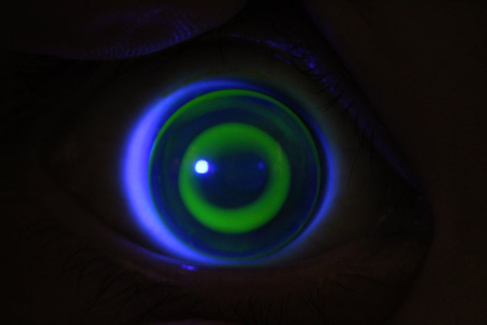 視覺科學博士視光師 Dr. Marco 角膜矯視OK鏡個案分享: 活躍小女孩A