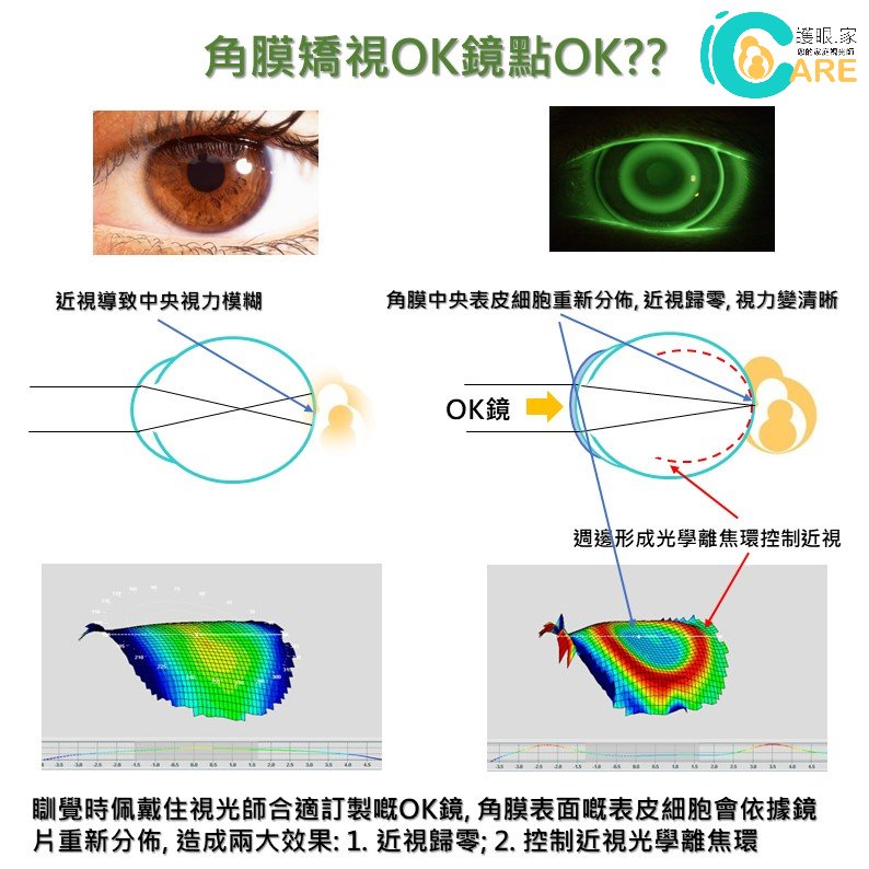 角膜矯視OK鏡/角膜矯形術驗配評估 - iCARE EYECARE 護眼·家